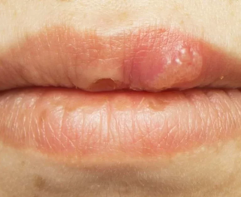 Diagnosis & Treatment of HPV Bumps on Lips